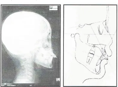 Gambar 5 Analisis sefalometri sebelum insersi oral screen 