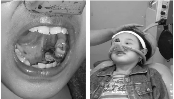 Gambar 4. Keadaan rongga mulut pasien setelah perawatan