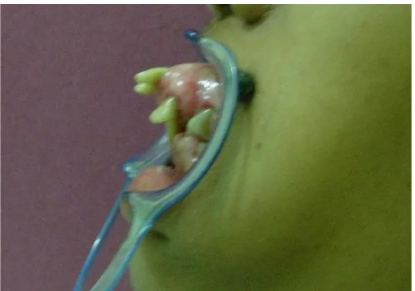 Gambar 2. Tampakan rongga mulut pasien dari samping