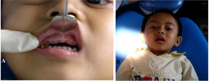 Gambar 1. A. Keadaan gigi geligi sebelum perawatan. B. Saat perawatan