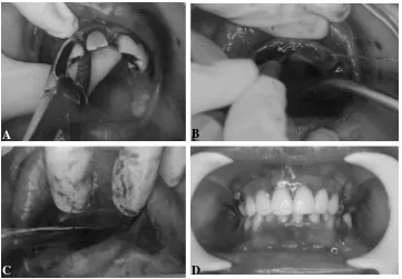 Gambar 5. Perbandingan keadaan intra oral penderita. A. Sebelum perawatan.B. Setelah perawatan.