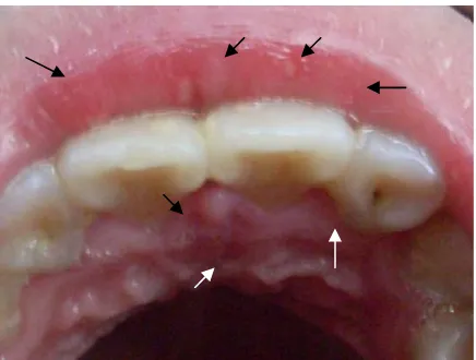 Gambar 2. Gambaran klinis pada kunjungan pertama. A. Pada bibir bawah terdapat ulser, multipel,menyebar, diameter 1-2 mm, sakit, warna putih kekuningan dikelilingi kemerahan