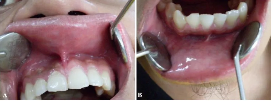 Gambar 4. Gambaran klinis pada kunjungan ketiga. A. Pada mukosa bibir bawah terdapat ulser,mutipel, menyebar, diameter 0,5 mm, warna  putih kekuningan, dikelilingi kemerahan,tidak sakit