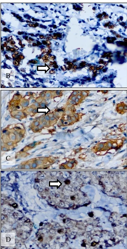 Tabel 3. Distribusi Ekspresi Protein Topoisomerase II α pada Berbagai Derajat Histopatologik Karsinoma Duktal Invasif Payudara