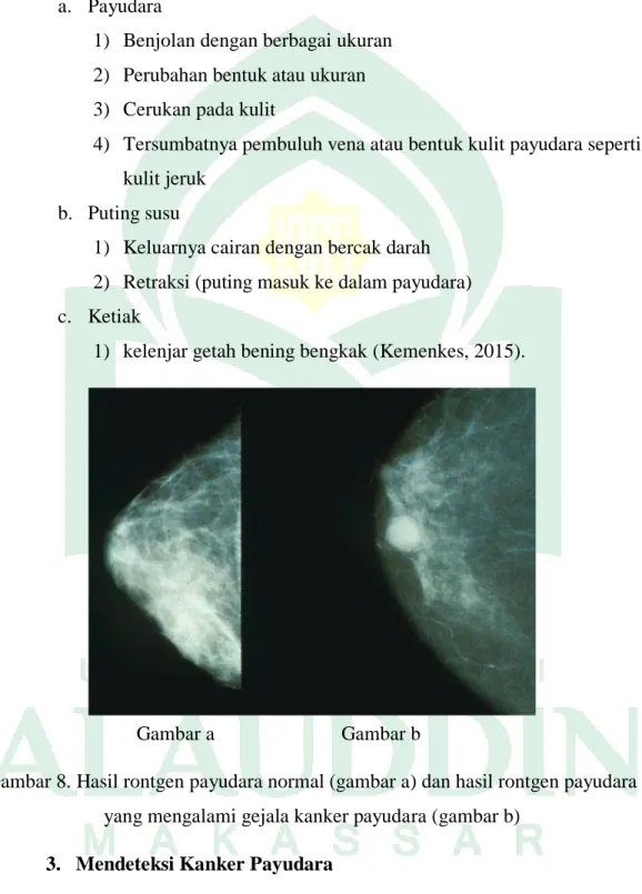 Gambar 8. Hasil rontgen payudara normal (gambar a) dan hasil rontgen payudara  yang mengalami gejala kanker payudara (gambar b) 