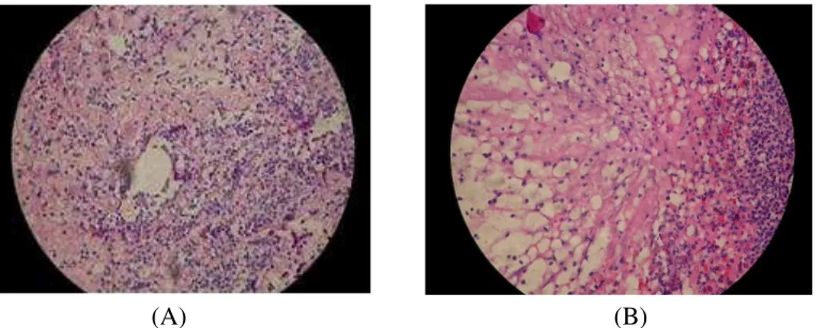Gambar 2.  Fotomikroskopik gambaran leukosit PMN (sel yang berbentuk bulat dengan inti berbentuk tapal kuda yang terletak dipinggir,  berwarna biru keunguan dan sitoplasma yang berwarna merah terang dengan pengecatan hematoksilin-eosin HE) pada  penyembuha