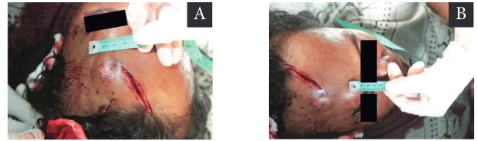 Gambar 2.  Terdapat dua buah memar pada dahi akibat luka bacok. Luka pertama terletak  dekat alis (Gamabar 2 A), luka kedua terletak di atas luka pertama(Gambar 2B)