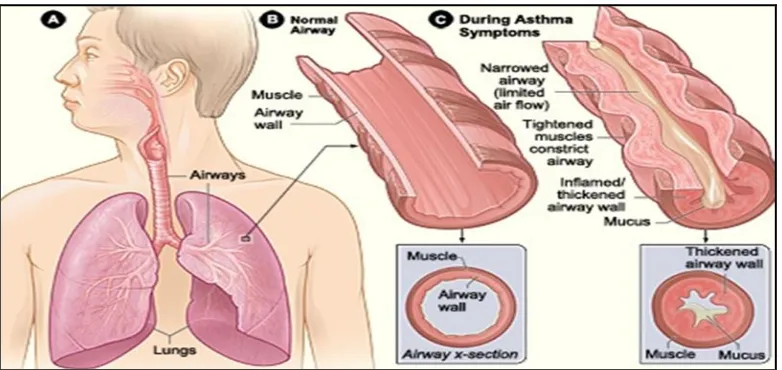 Gambar 5. Penyempitan saluran napas pada asma. 