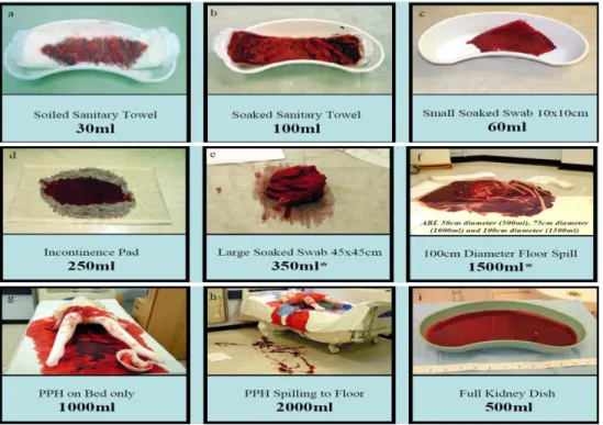 Gambar 1 Estimasi Kehilangan Darah  6.  Faktor-Faktor Yang Mempengaruhi Persalinan 