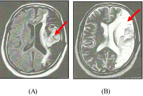 Gambar 2.4 Glioma di lobus parietal, potongan aksial. 