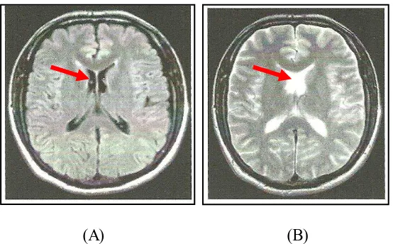 Gambar 2.2 MRI otak normal, potongan aksial, CSS di ventrikel lateral 
