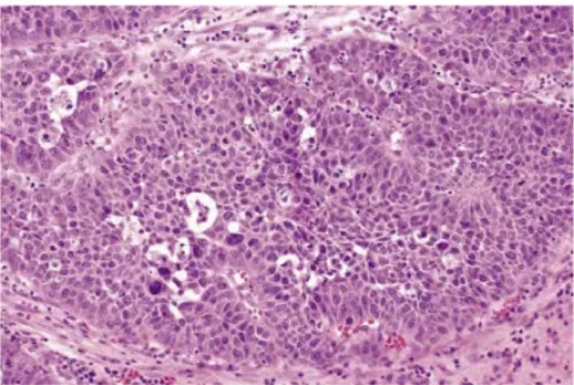 Gambar 2.6 Karsinoma sel skuamosa berkeratin pada nasofaring      (Barnes, 2009) 