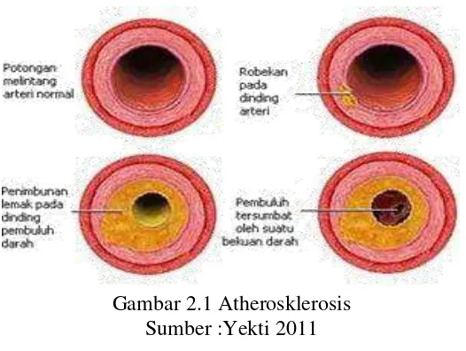 Gambar 2.1 Atherosklerosis 