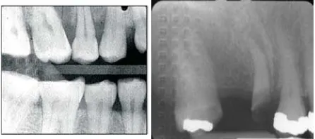Gambar 8. Dot artifacts pada     Akar gigi insisivus    sentral.3 