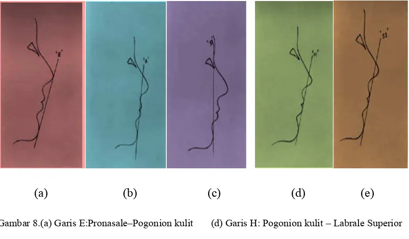 Gambar 8.(a) Garis E:Pronasale–Pogonion kulit       (d) Garis H: Pogonion kulit – Labrale Superior 