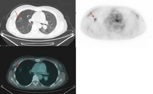 Figure 3. Left panel: CT image showing a 1.6  1.2-cm cavitating lesion (arrow) in the upper lobe of the right lung