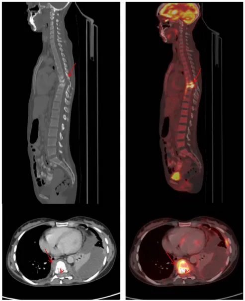 Figure 5. CT (left panel) and 18 F-FDG PET/CT fused images (right panel): trans-axial and sagittal sections