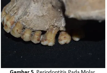 Gambar 5. Periodontitis Pada Molar 