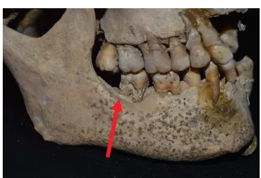 Gambar 1. Karies Gigi Pada Bagian Occlusal Molar Kedua Mandibula Kiri Individu III (Sumber: Dokumentasi Penulis) 