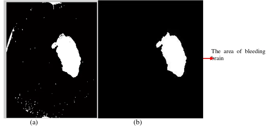 Table 1 shows the results of the calculation of the volume of the brain bleeding image area with the formula: The total pixels all slice * distance between slice * (number of slice - 1), the total pixels: 37.355,00 pixels 2, the distance between the slice: