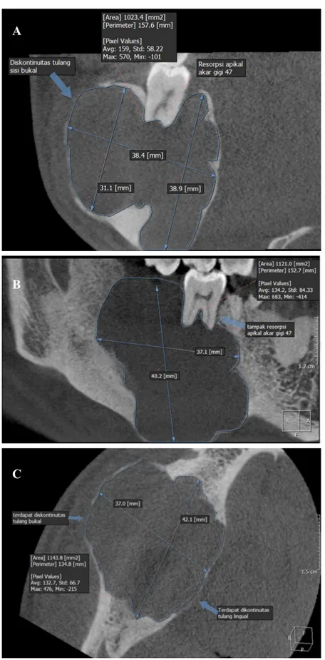 Gambar  3.  Analisis lesi pada radiograf CBCT 3D,  (A)  Coronal view, memperlihatkan lesi radiolusen berbentuk reguler  dengan batas jelas di apikal gigi 47 meluas ke bukal dan ke lingual, struktur internal radiolusen