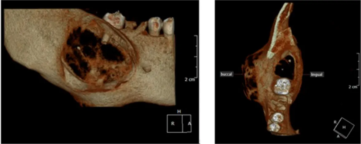 Gambar 4.  3D view radiograf CBCT memperlihatkan adanya lesi yang menyebabkan ekspansi rahang  ke arah lateral disertai adanya perforasi dinding bukal pada posterior mandibula 
