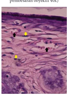 Gambar 3. Neovaskularisasi(    ) dan  Fibroblas 