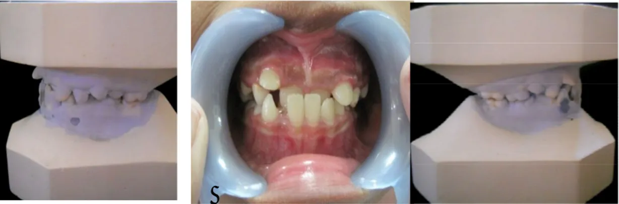 Gambar 2. Foto intra oral pasien sebelum perawatan (29/01/2010) 
