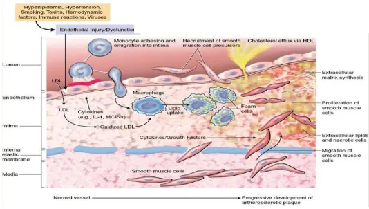 Gambar 4. Patofisiologi aterosklerosis (Veinot, 2010) 