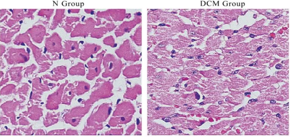 Gambar 2.5. Perbandingan gambaran histologi otot jantung normal (N)  dengan  kardiomiopati  diabetik  (DCM)