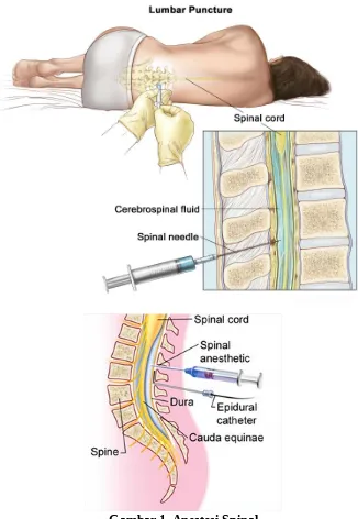 Gambar 1. Anestesi Spinal