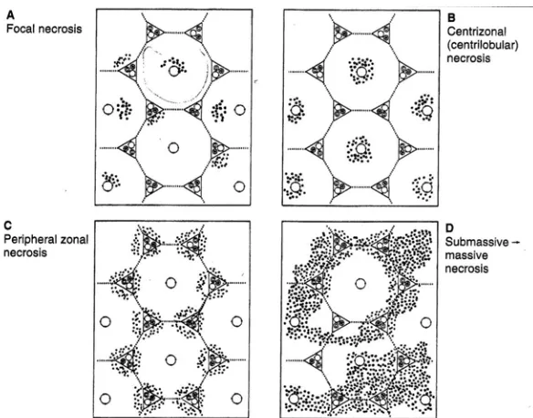 Gambar 2. Tipe-tipe Kerusakan Hati (Chandrasoma and Taylor, 1995) 