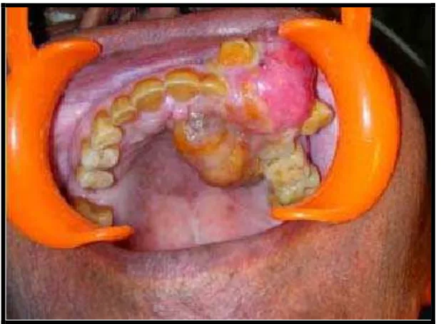 Gambar 5. Massa tumor yang telah dikeluarkan dari rongga mulut dengan tindakan pembedahan mandibulectomy (pemotongan mandibula) dari premolar pertama kiri ke premolar pertama kanan.6  