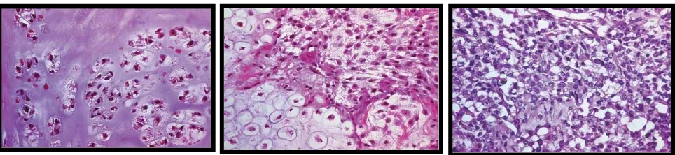 Gambar 6. Gambaran histopatologis chondrosarcoma yang menunjukkan adanya mitosis atau pembelahan sel