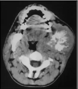 Gambar 8. Gambaran radiografi chondrosarcoma yang dilihat melalui foto panoramik. Pada foto terlihat adanya area radiolusen di regio anterior maksila (tanda panah).5  