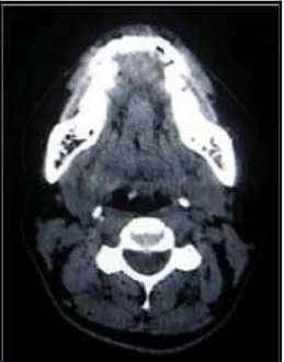 Gambar 9. Gambaran radiografi chondrosarcoma yang dilihat melalui foto oklusal. Pada foto terlihat adanya area radiolusen di regio anterior mandibula.6  