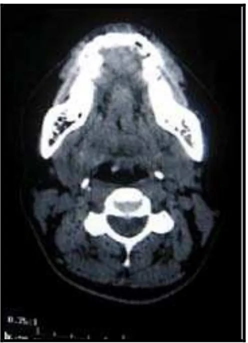 Gambar 12. Foto oklusal yang menunjukkan are radiolusen di pertengahan mandibula yang menyebabkan bergeraknya akar gigi insisivus sentralis