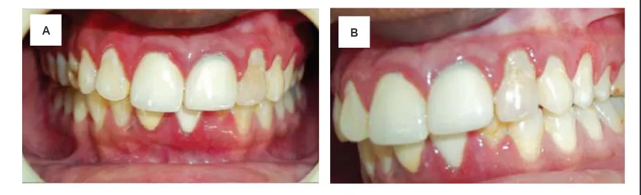 Gambar 1. Kondisi gingivitis ringan: (A) Sebelum menggunakan pasta gigi yang mengandung propolis (B) Setelah menggunakan pasta gigi yang mengandung propolis.