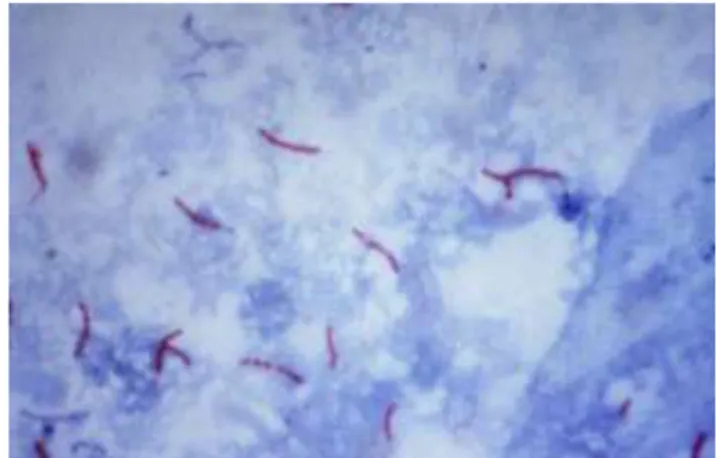 Gambar 1. Citra pemeriksaan mikroskopis dahak penderita TBC . 