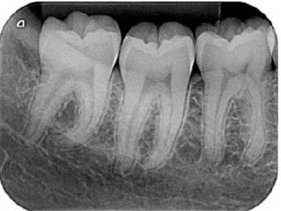 Gambar  2.  Gambaran dari radiograf periapikal  yang  dikatakan  lengkap  dimana  objek  gigi   46-48 yang diminta secara anatomi terlihat jelas 9 