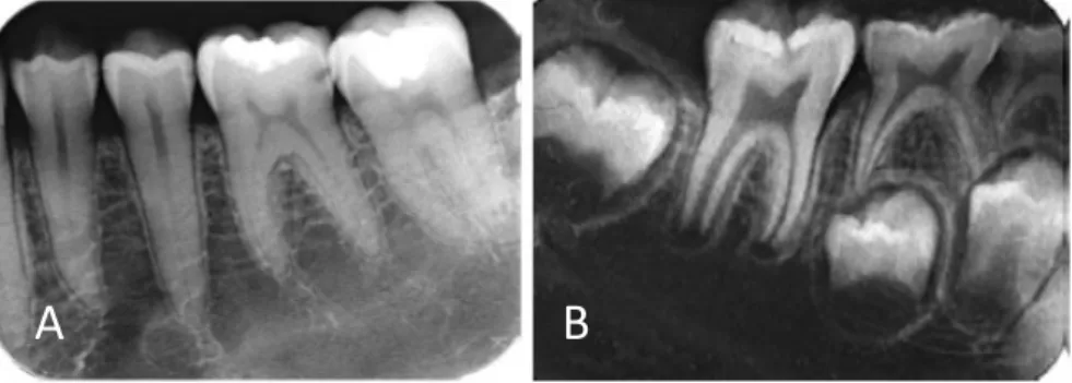 Gambar 7. Radiograf dengan detail yang baik, (a) menampakkan detail   seluruh struktur anatomi gigi dewasa; dan (b) pada gigi anak-anak 11 