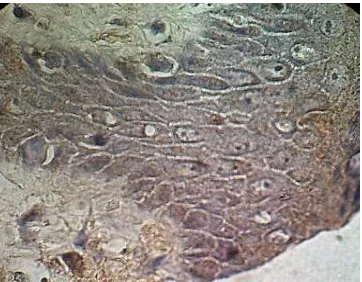 Gambar 2. Ekspresi EGFR pada sel epitel pasien bibir sumbing ras protomalayid   