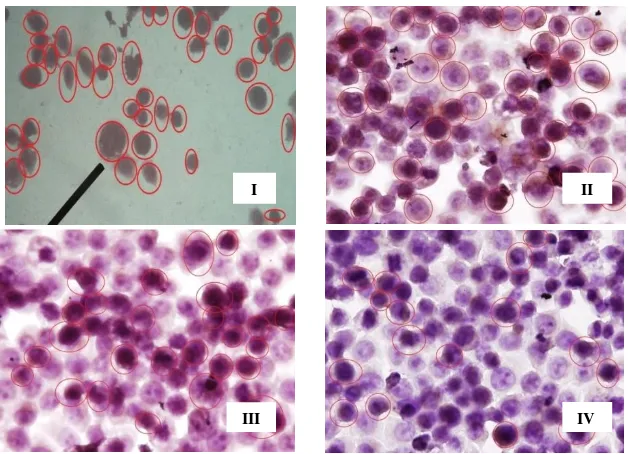 Gambar 2. Ekspresi Bcl-2 pada sel HeLa yang berwarna coklat (lingkaran merah) yang dideteksi dengan metode imunohistokimia (1000x)