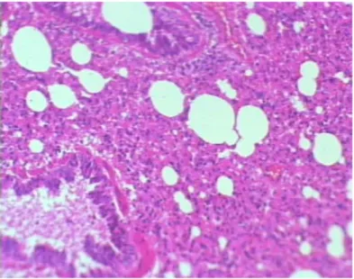 Gambar 2. Pneumonia interstitialis non supuratif dengan penebalan alveoli oleh sel limfositik pewarnaan H &amp; E (16 x 10) Lesi yang berupa pneumonia supuratif dalam bentuk 
