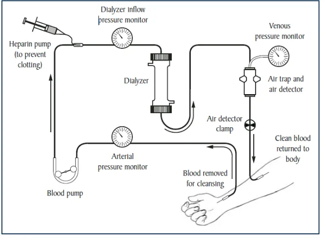 Gambar 2.1. Mekanisme hemodialisis Sumber : NIDDK, 2006  