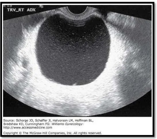 Gambar 3. Gambaran ultrasonografi endometrioma ovarium 