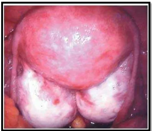 Gambar 4. Gambaran endometrioma pada kedua ovarium (kissing 