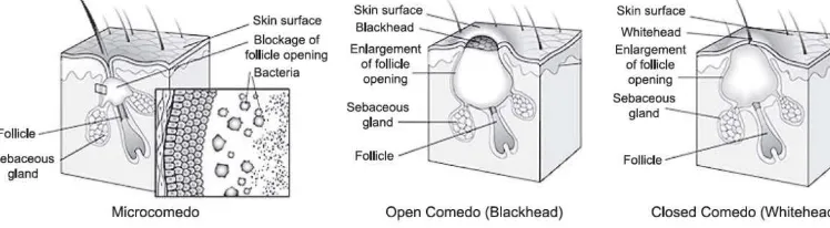 Gambar 2.4. Tipe-tipe lesi acne comedonal (Manchini, 2008) 