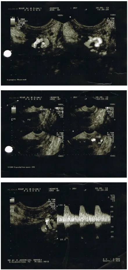 Gambar 1. Tampak gambaran hiperplasia endometrium (endline : 11,2 mm)