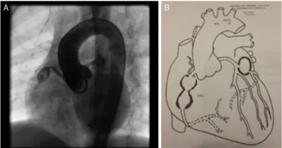 Figura 2 A. Cateterismo cardíaco en el que se observan dos aneurismas en arteria coronaria derecha ACD (R-right - proximal visible y distal parcialmente visible) y un aneurisma en arteria coronaria izquierda - ACI